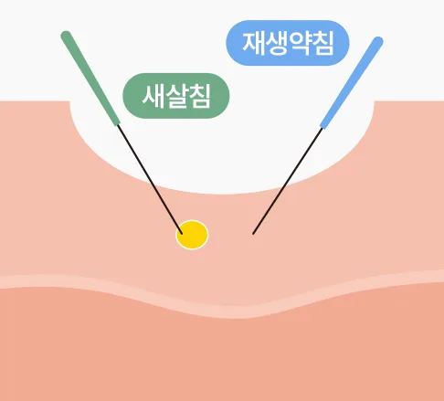STEP 01 — 皮下剥离再生针疗法原理