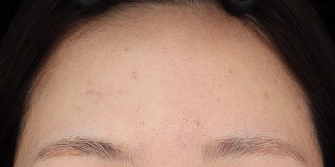 recovery scar therapy after