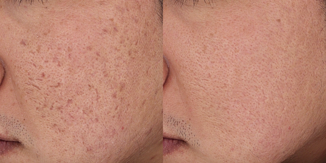 recovery scar therapy effect 1