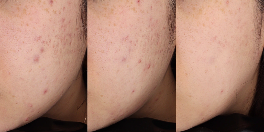 recovery scar therapy effect 2