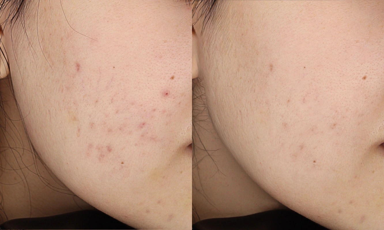 acne treatment effect 1