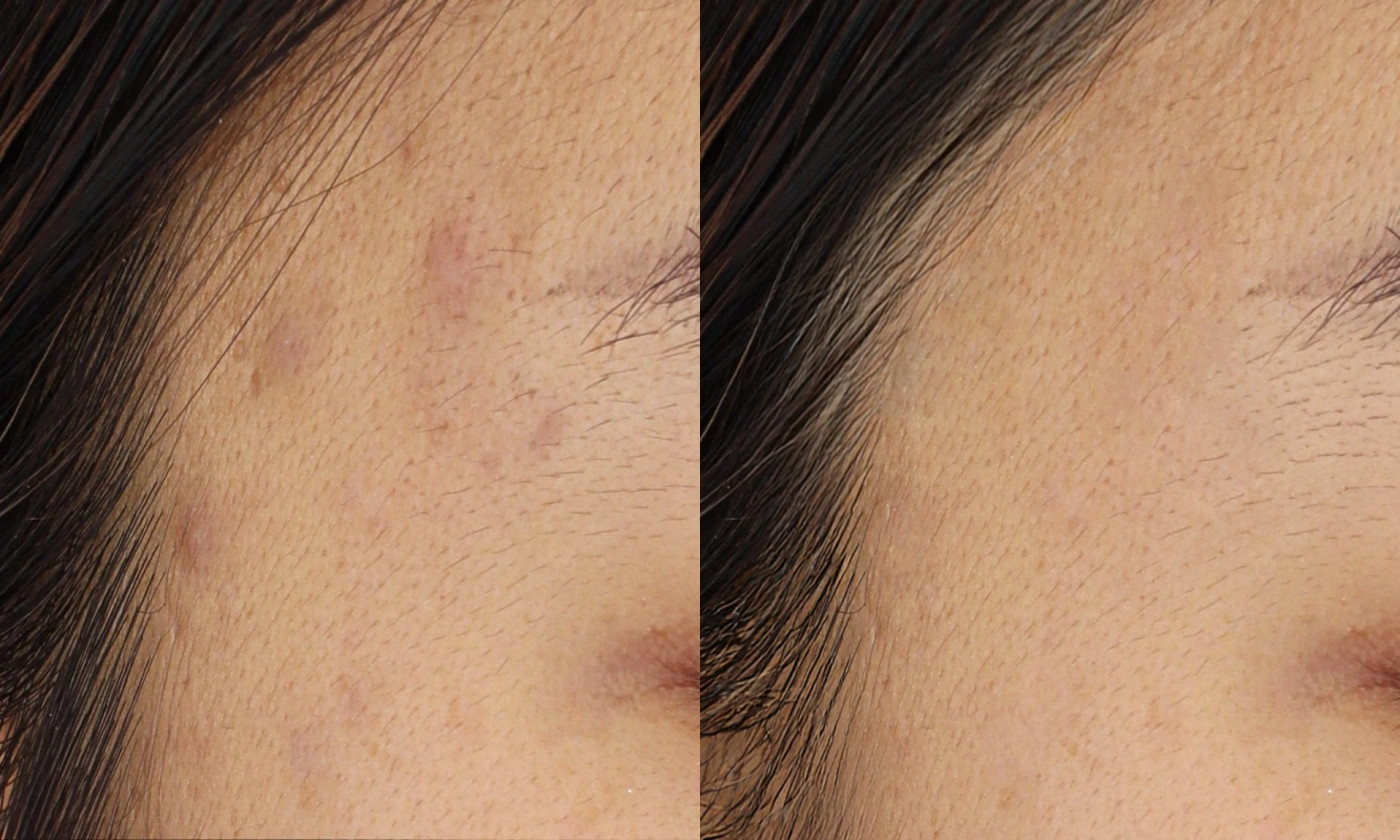 acne treatment effect 2