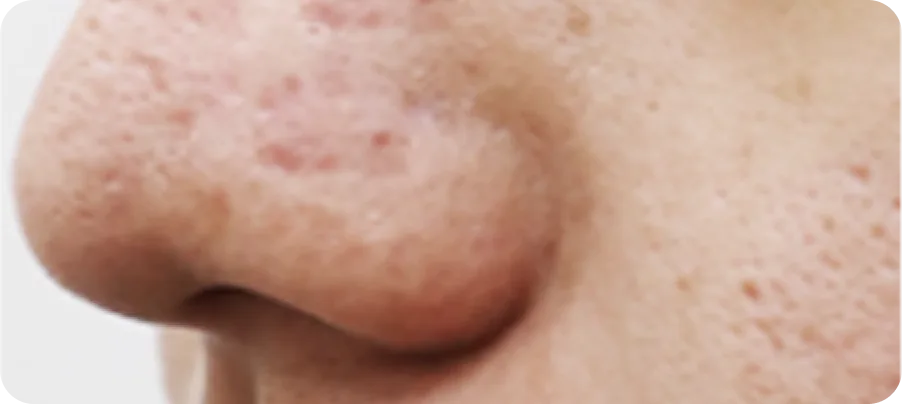 鼻部、人中痤疮凹陷瘢痕
